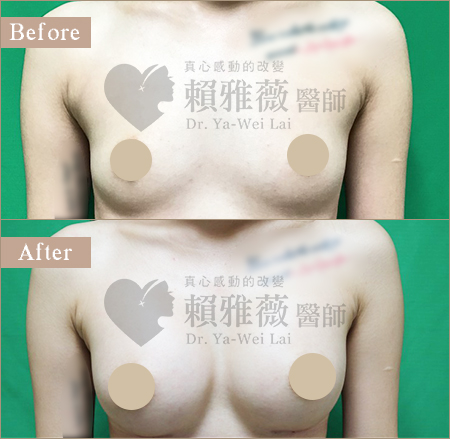 水滴形隆乳案例