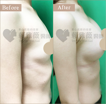 水滴形隆乳案例
