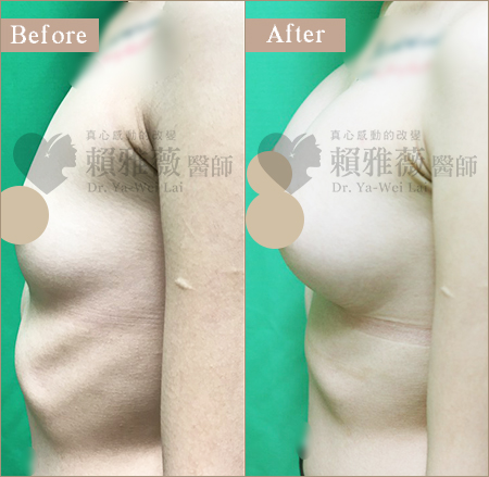 水滴形隆乳案例