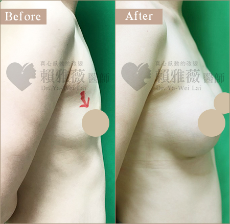 圓盤絨毛面隆乳案例