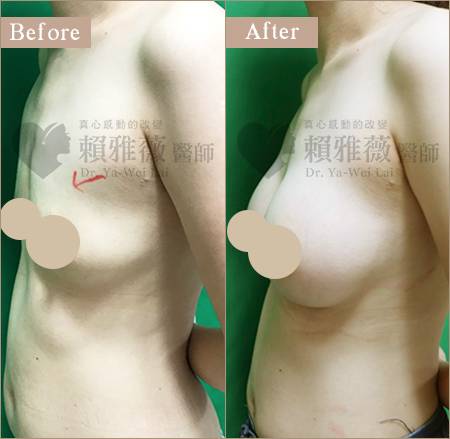 圓盤絨毛面隆乳案例