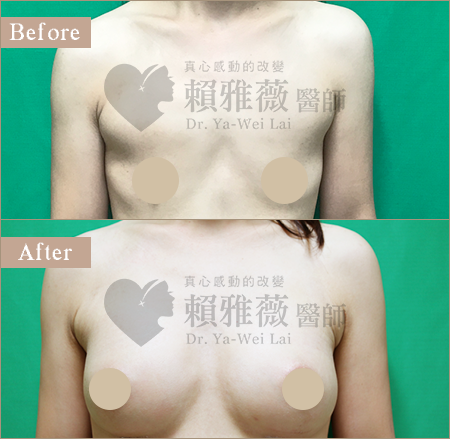 圓盤光滑面隆乳案例