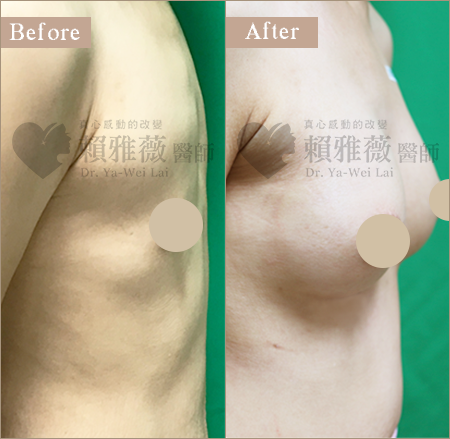 圓盤光滑面隆乳案例