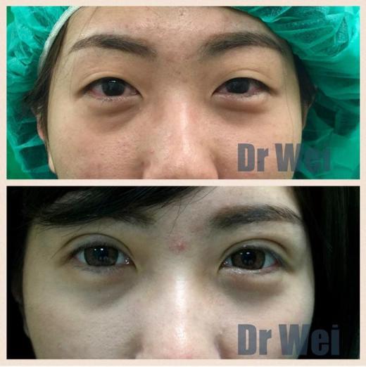 高雄雙眼皮手術案例 高雄雙眼皮手術案例
