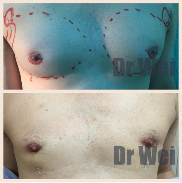 高雄男性女乳治療案例 高雄男性女乳治療案例