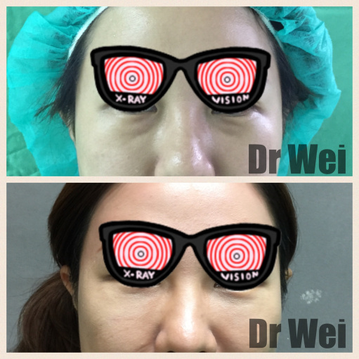 內開眼袋合併自體脂肪脂肪補臥蠶 內開眼袋合併自體脂肪脂肪補臥蠶