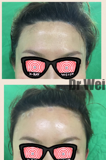 自體脂肪補額頭 自體脂肪補額頭