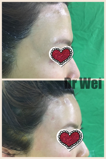 水刀抽脂補額頭 水刀抽脂補額頭