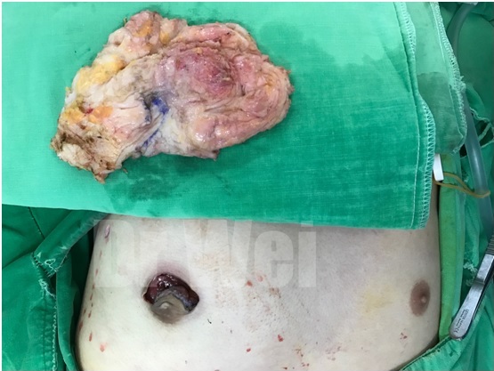 高雄男性女乳手術案例 高雄男性女乳手術案例