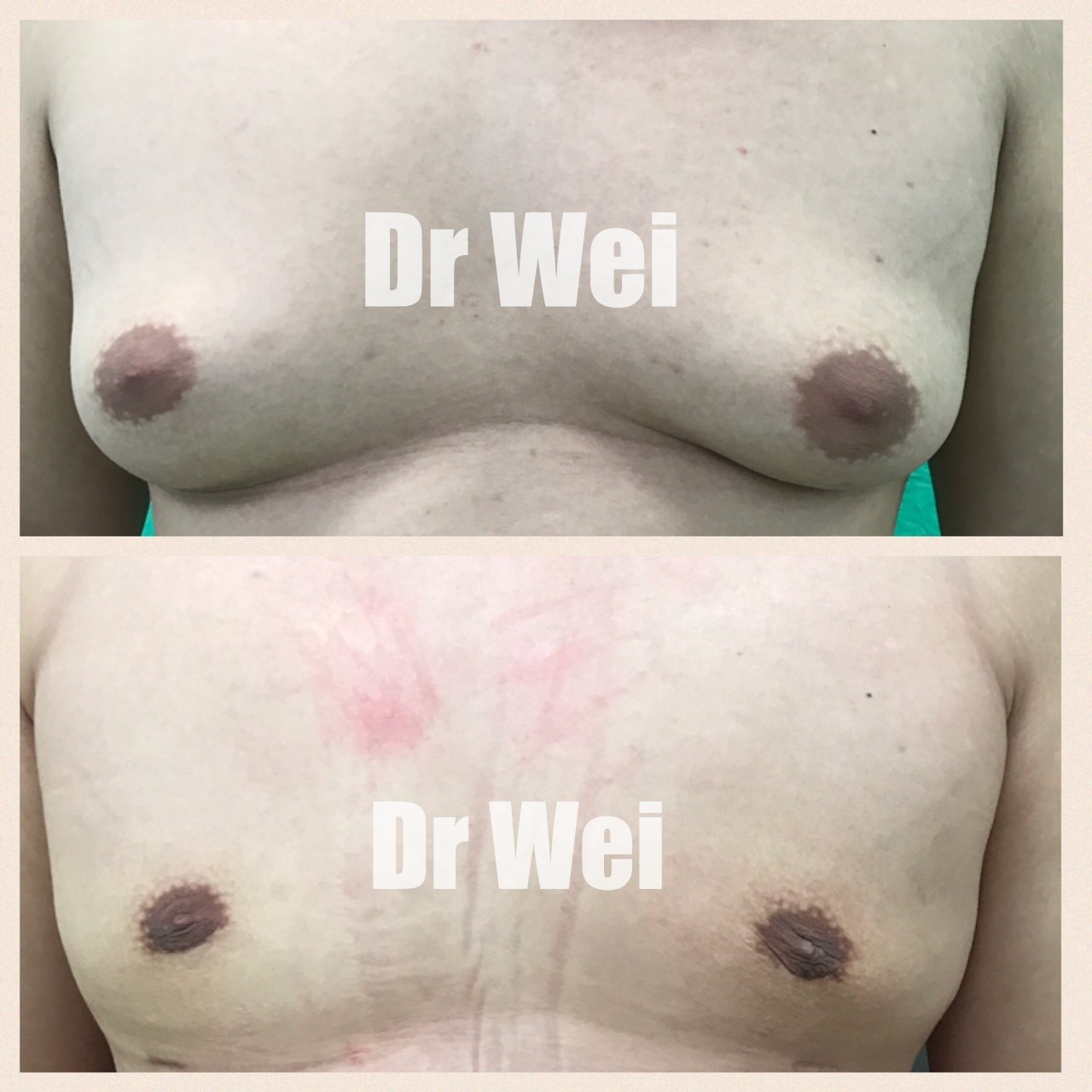 高雄男性女乳治療案例 高雄男性女乳治療案例