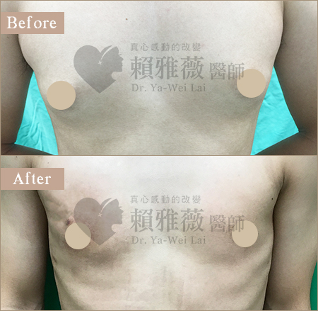 男性女乳症案例