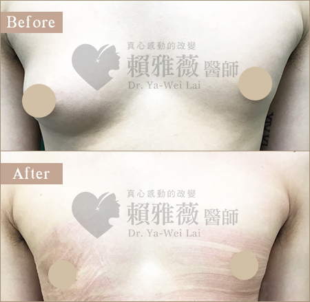 男性女乳症案例