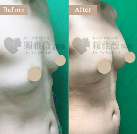 自體脂肪豐胸隆乳案例