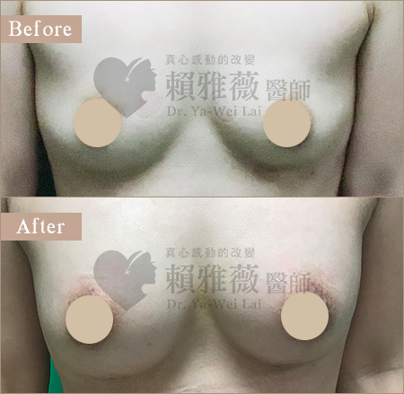 自體脂肪隆乳案例