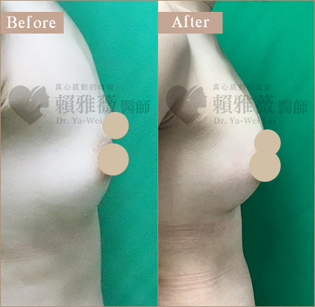 自體脂肪豐胸案例