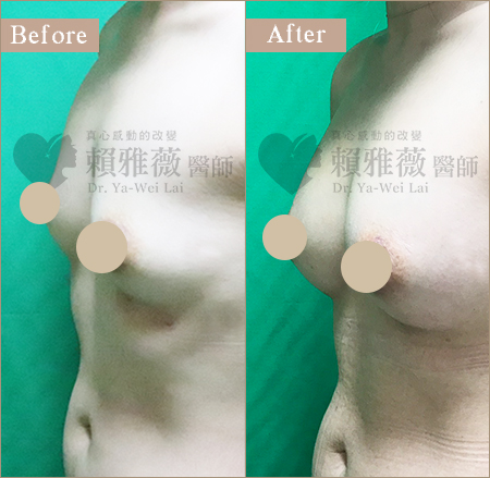 自體脂肪隆乳案例