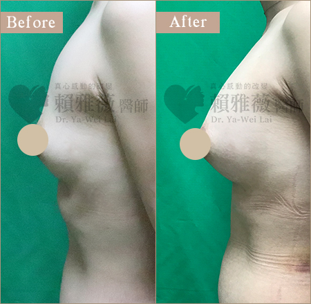 自體脂肪豐胸隆乳案例