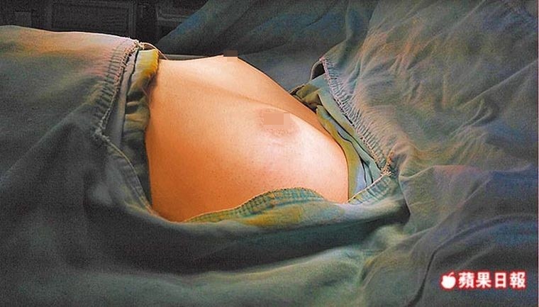 男性女乳症成因多 勤健身也練不出大肌肌